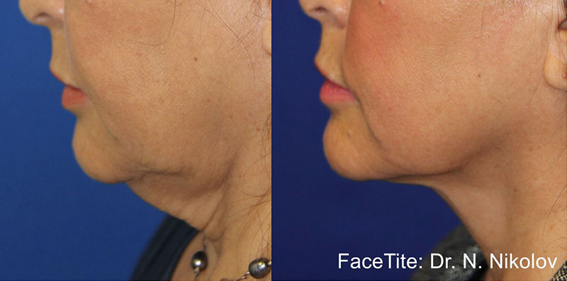 Before and After image of a patient who underwent the Facetite treatment.