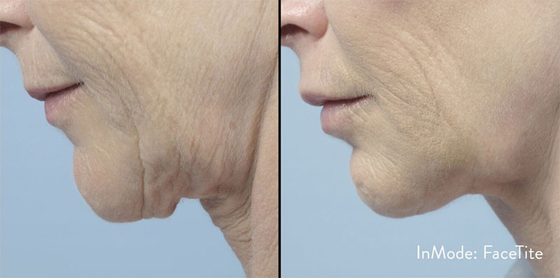 Before and After image of a patient showing the effects of the FaceTite treatment