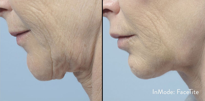 FaceTite 2 Before and After image of a patient showing the effects of the FaceTite treatment