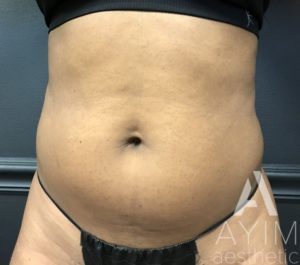 Liposuction: Before & After Photos Case 870 Before Photo Liposuction: Before & After Photos