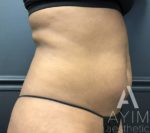 Liposuction: Before & After Photos