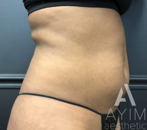 Liposuction: Before & After Photos Case 870 Before Photo Liposuction: Before & After Photos