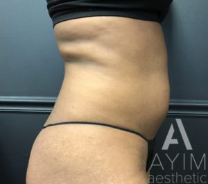 Liposuction: Before & After Photos Case 870 Before Photo Liposuction: Before & After Photos