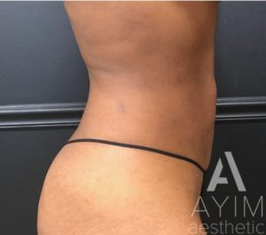 Liposuction: Before & After Photos Case 870 After Photo Liposuction: Before & After Photos