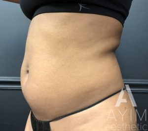 Liposuction: Before & After Photos Case 870 Before Photo Liposuction: Before & After Photos