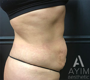 Bodytite: Before & After Photos