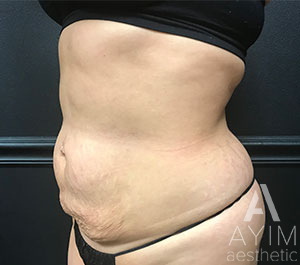 Bodytite: Before & After Photos