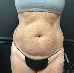 Bodytite Before and After Results