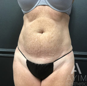 Bodytite Before and After Results