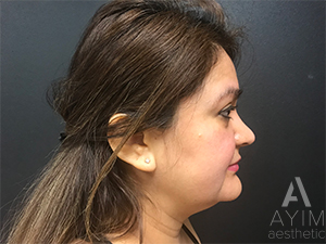 Facetite: Before & After Photos Case 1030 Before Photo Facetite: Before & After Photos