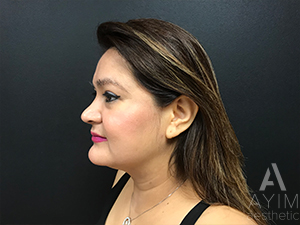 Facetite: Before & After Photos Case 1030 After Photo Facetite: Before & After Photos