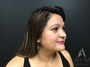 Facetite: Before & After Photos Case 1030 After Photo Facetite: Before & After Photos