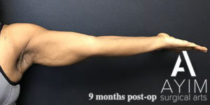 Bodytite: Before & After Photos Case 1256 After Photo Bodytite: Before & After Photos