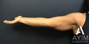 Bodytite: Before & After Photos Case 1256 Before Photo Bodytite: Before & After Photos