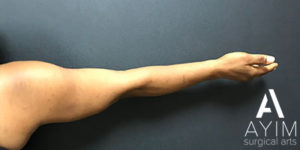 Bodytite: Before & After Photos Case 1256 Before Photo Bodytite: Before & After Photos