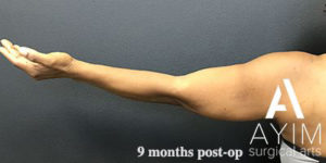 Bodytite: Before & After Photos Case 1256 After Photo Bodytite: Before & After Photos