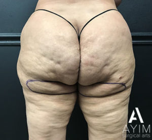 Bodytite: Before & After Photos