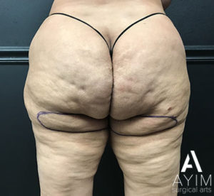 Bodytite: Before & After Photos Case 1265 Before Photo Bodytite: Before & After Photos
