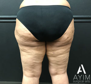 Bodytite: Before & After Photos Case 1265 After Photo Bodytite: Before & After Photos