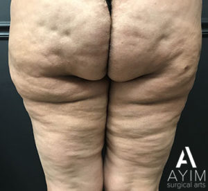 Bodytite: Before & After Photos Case 1265 Before Photo Bodytite: Before & After Photos