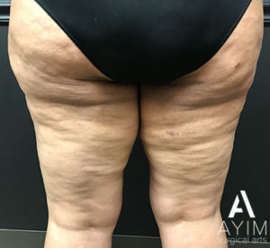 Bodytite: Before & After Photos Case 1265 After Photo Bodytite: Before & After Photos
