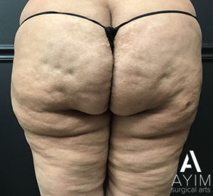 Bodytite: Before & After Photos Case 1265 Before Photo Bodytite: Before & After Photos