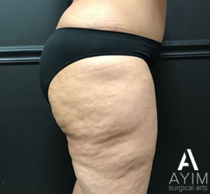 Bodytite: Before & After Photos Case 1265 After Photo Bodytite: Before & After Photos