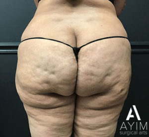 Bodytite: Before & After Photos Case 1265 Before Photo Bodytite: Before & After Photos