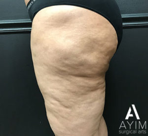 Bodytite: Before & After Photos Case 1265 After Photo Bodytite: Before & After Photos