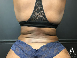 Bodytite: Before & After Photos Case 1230 After Photo Bodytite: Before & After Photos