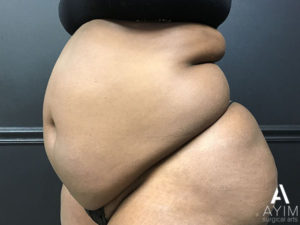 Bodytite: Before & After Photos Case 1230 Before Photo Bodytite: Before & After Photos