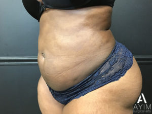 Bodytite: Before & After Photos Case 1230 After Photo Bodytite: Before & After Photos