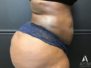 Bodytite: Before & After Photos Case 1230 After Photo Bodytite: Before & After Photos