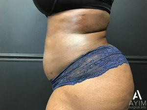 Bodytite: Before & After Photos Case 1230 After Photo Bodytite: Before & After Photos
