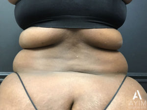 Bodytite: Before & After Photos Case 1230 Before Photo Bodytite: Before & After Photos