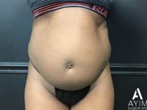 Bodytite: Before & After Photos Case 1302 Before Photo Bodytite: Before & After Photos