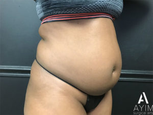 Bodytite: Before & After Photos Case 1302 Before Photo Bodytite: Before & After Photos