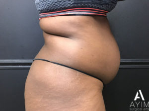 Bodytite: Before & After Photos Case 1302 Before Photo Bodytite: Before & After Photos