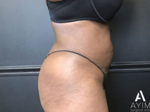 Bodytite: Before & After Photos Case 1302 After Photo Bodytite: Before & After Photos