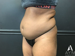 Bodytite: Before & After Photos Case 1302 Before Photo Bodytite: Before & After Photos