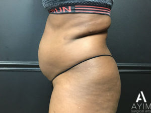 Bodytite: Before & After Photos Case 1302 Before Photo Bodytite: Before & After Photos