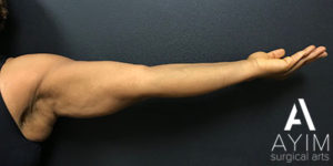 Bodytite: Before & After Photos Case 1256 After Photo Bodytite: Before & After Photos