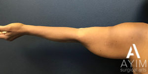 Bodytite: Before & After Photos Case 1256 Before Photo Bodytite: Before & After Photos