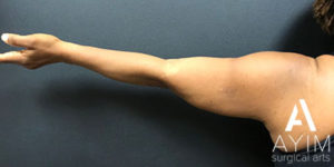 Bodytite: Before & After Photos Case 1256 After Photo Bodytite: Before & After Photos