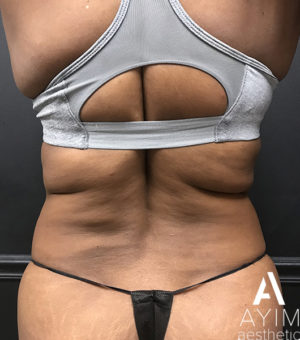 Liposuction: Before & After Photos