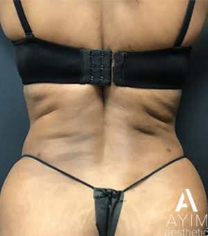 Liposuction: Before & After Photos