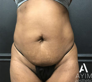 Liposuction: Before & After Photos