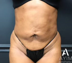 Liposuction: Before & After Photos