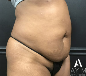 Liposuction: Before & After Photos