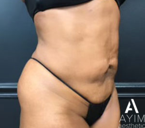 Liposuction: Before & After Photos